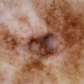 Melanoma on severely sun-damaged skin